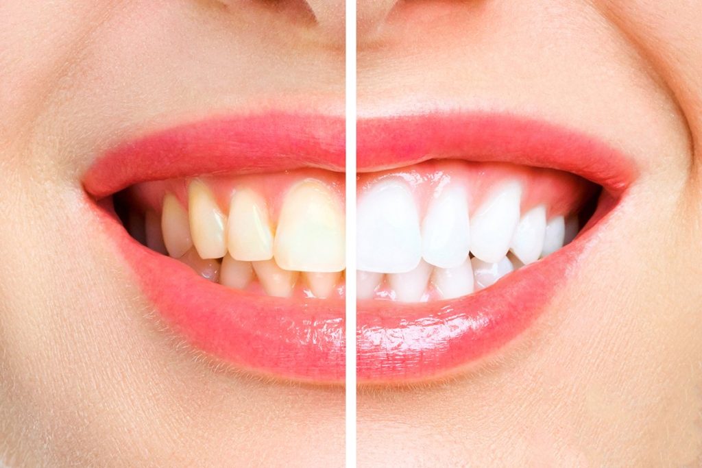 woman teeth before and after whitening image symbolizes stomatology (2)